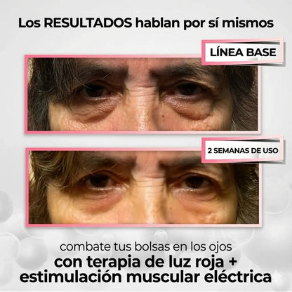 RevitaOjos - Dispositivo Antiedad de Luz Roja y EMS para Eliminar Bolsas, Ojeras y Hinchazón